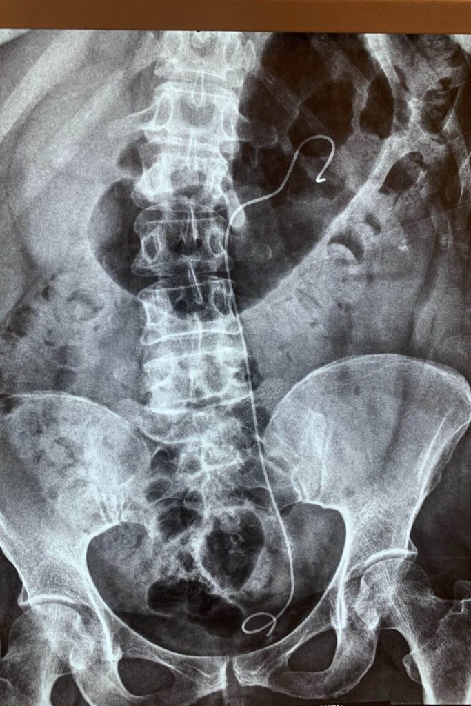 ΜΕΤΑ ΤΗΝ ΤΟΠΟΘΕΤΗΣΗ ΣΤΕΝΤ 