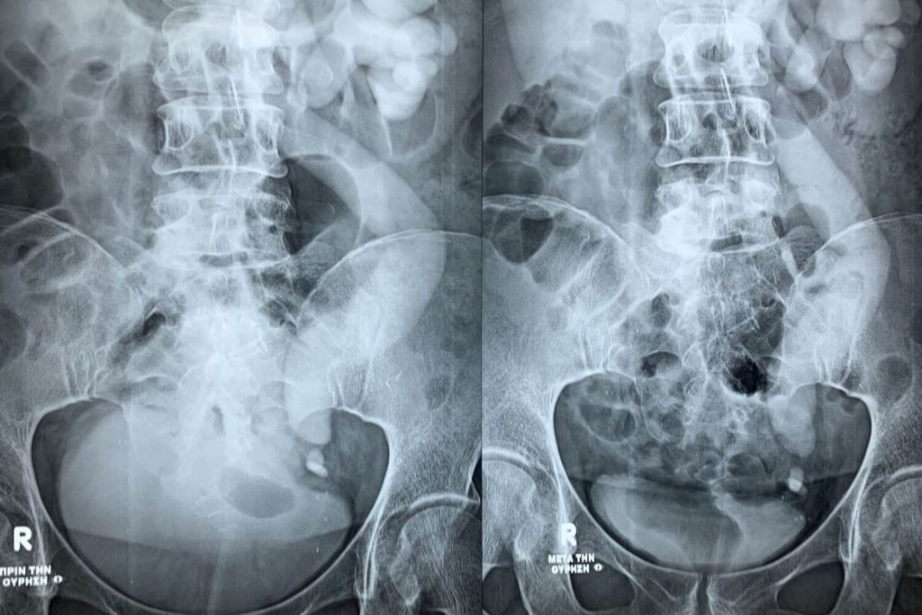 ΠΡΙΝ/ΜΕΤΑ ΤΗΝ ΟΥΡΗΣΗ